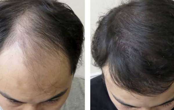 FUE vs FUT Hair Transplant