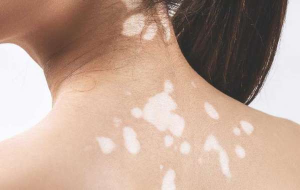 Vitiligo Can Be Treated Efficiently By The Best Dermatologist In Delhi