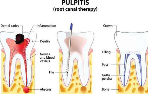 Tooth Care With The Best Root Canal Treatment in Gurgaon