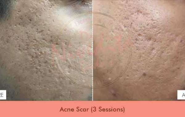 Best Acne Scars Treatment in Delhi | Acne Scars Treatment in Delhi