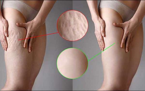 9 Cellulite Treatments That Work