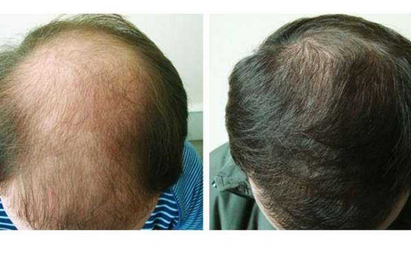 FUE Hair Transplant in Palm Desert