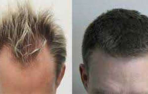 How Hair Restoration Can Change Your Life?